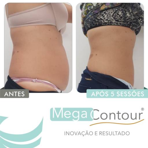 Tratamento para Gordura Localizada em Aracaju, SE por Estética Anna Paula