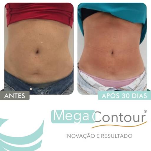 Tratamento para Gordura Localizada em Aracaju, SE por Estética Anna Paula