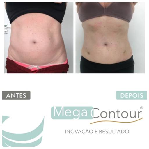 Tratamento para Gordura Localizada em Aracaju, SE por Estética Anna Paula