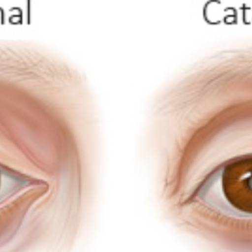Cirurgia de catarata por Clinica de Olhos Prime