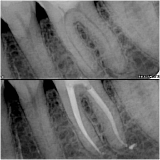 O tratamento endodôntico, popularmente conhecido como 