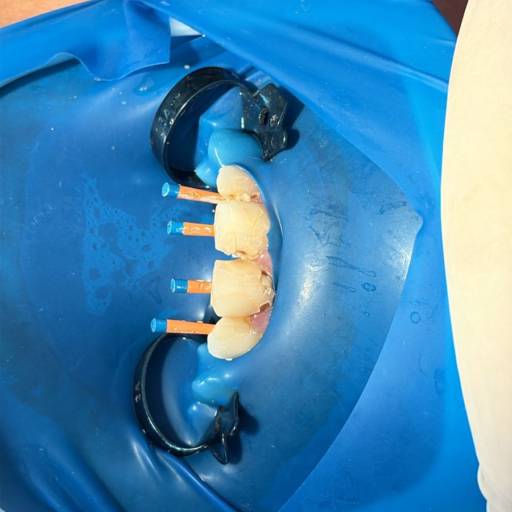 Tratamento de Canal - Endodontia