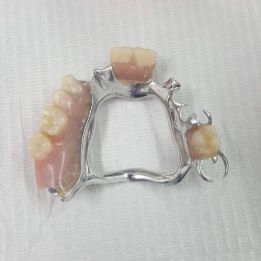 Prótese Parcial Removível  por Dra. Nathália Quirino Bueno