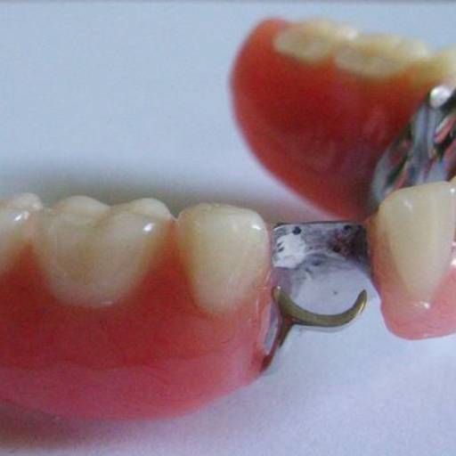 Prótese Parcial Removível  por Dra. Nathália Quirino Bueno