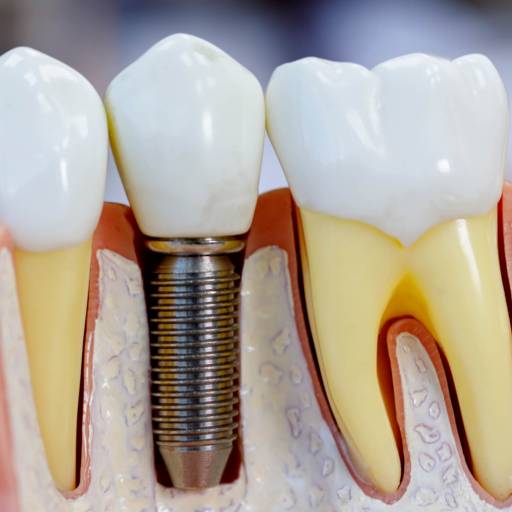 Implantes Dentários  por Odous Centro Odontológico