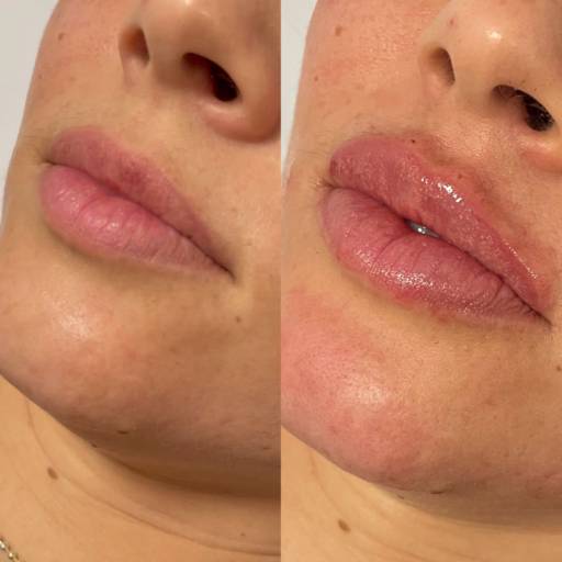 Comprar o produto de PREENCHIMENTO LABIAL em Clínicas de Estética e Beleza pela empresa BELAGIO em Botucatu, SP por Solutudo