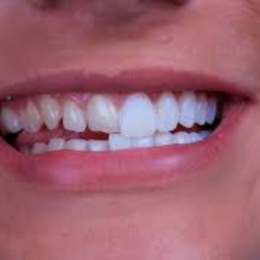 Comprar o produto de FACETAS DENTÁRIAS  em Odontologia pela empresa Odontologia Cláudio Assunção em Americana, SP por Solutudo