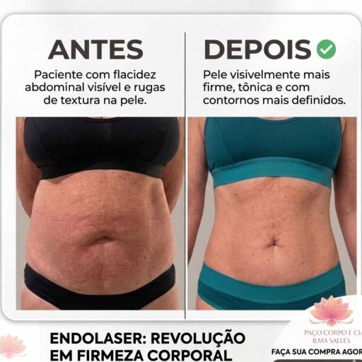 Endolaser - Trata Flacidez e Gordura Localizada