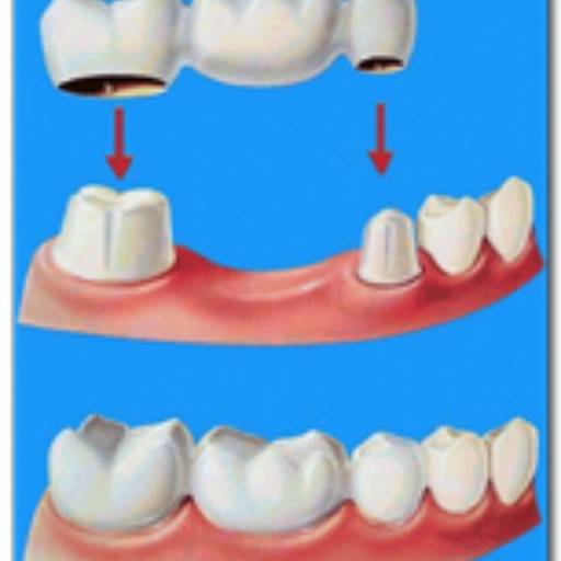 Prótese Fixa em Bauru