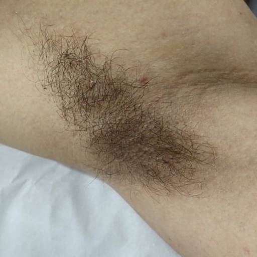 Depilação de Axilas Masculina em Americana, SP por Vilas Boas Instituto de Depilação 