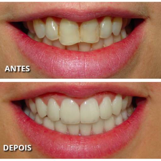 Facetas por Lopes Saúde e Odontologia