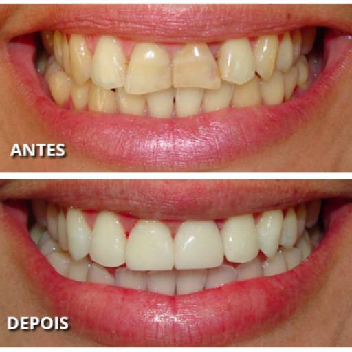Facetas por Lopes Saúde e Odontologia