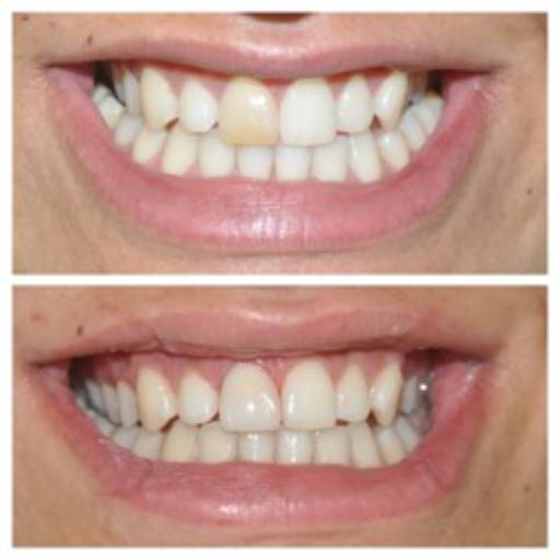 Facetas por Lopes Saúde e Odontologia