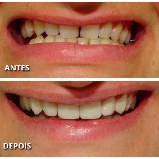 Facetas por Lopes Saúde e Odontologia