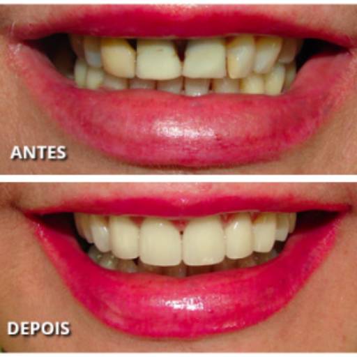 Facetas por Lopes Saúde e Odontologia