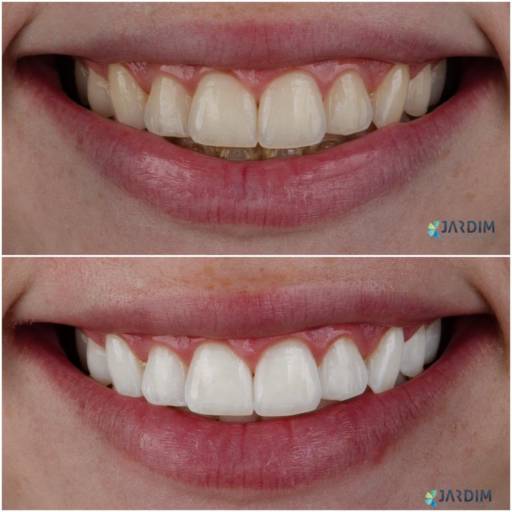 O Clareamento dental é um dos tratamentos estéticos mais procurados porque transforma muito mais do que o sorriso: ele eleva a autoestima e a confiança. Realizado de forma segura, com acompanhamento profissional, proporciona dentes naturalmente mais claros sem comprometer a saúde da estrutura dental.
O clareamento revela um sorriso mais radiante em pouco tempo. É a união perfeita entre estética e saúde, proporcionando dentes claros, brilho natural e a sensação imediata de renovação.