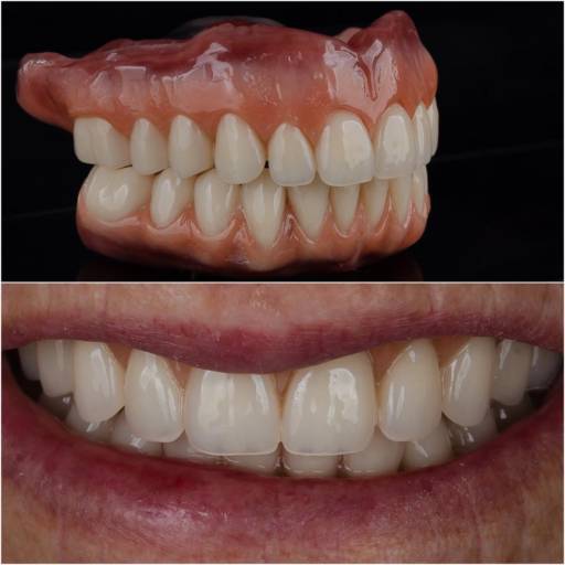 A perda dos dentes não significa o fim do sorriso. A prótese total devolve muito mais do que a função de mastigar e falar bem: ela resgata a autoestima, a confiança e a alegria de sorrir sem receios. 
Hoje é possível confeccionar próteses confortáveis, estáveis e com aparência natural, que se adaptam ao seu jeito de viver. Cada detalhe é pensado para que o paciente volte a sentir-se seguro em momentos simples do dia a dia- compartilhar uma refeição, conversar, sorrir para uma foto. 
Reabilitar um sorriso é, também, restituir qualidade de vida e devolver histórias que merecem continuar sendo vividas com plenitude.  A perda dos dentes não significa o fim do sorriso. A prótese total devolve muito mais do que a função de mastigar e falar bem: ela resgata a autoestima, a confiança e a alegria de sorrir sem receios. 
Hoje é possível confeccionar próteses confortáveis, estáveis e com aparência natural, que se adaptam ao seu jeito de viver. Cada detalhe é pensado para que o paciente volte a sentir-se seguro em momentos simples do dia a dia- compartilhar uma refeição, conversar, sorrir para uma foto. 
Reabilitar um sorriso é, também, restituir qualidade de vida e devolver histórias que merecem continuar sendo vividas com plenitude.