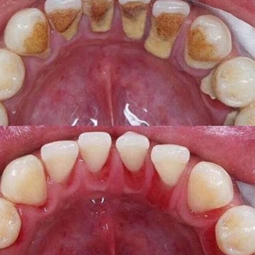 Raspagem Periodontal 