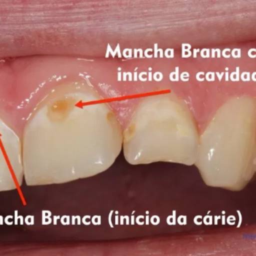 Restauração Estética por Dra. Nathália Quirino Bueno