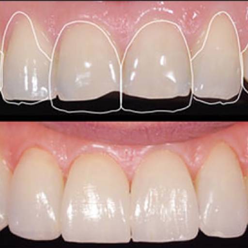 Restauração Estética por Dra. Nathália Quirino Bueno