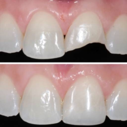 Restauração Estética por Dra. Nathália Quirino Bueno