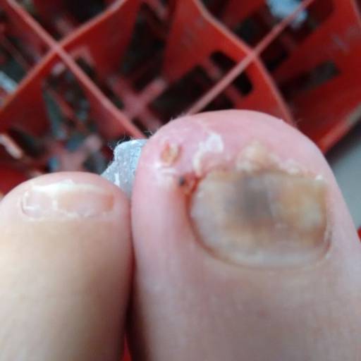 Onicocriptose com onicomicose