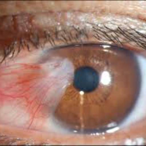 Cirurgia pterígio  por Clinica de Olhos Prime