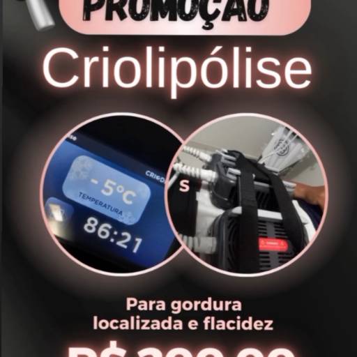 Criolipólise de placas 