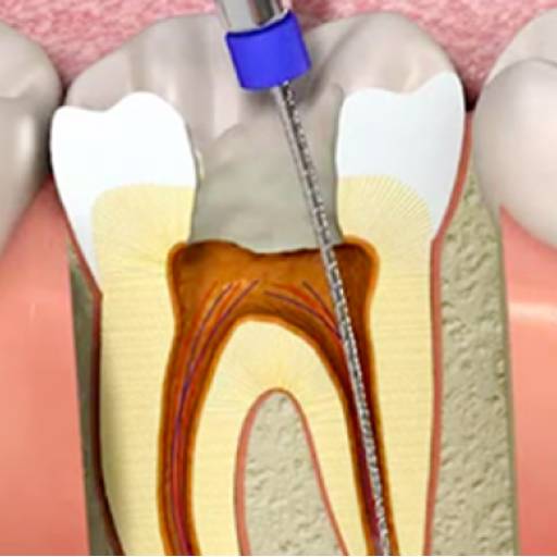 Tratamento de Canal por Odous Centro Odontológico