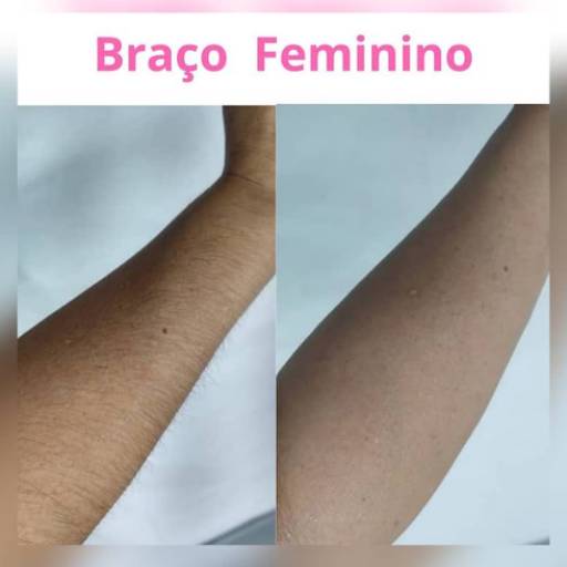 Depilação Braço Feminino  em Americana, SP por Vilas Boas Instituto de Depilação 
